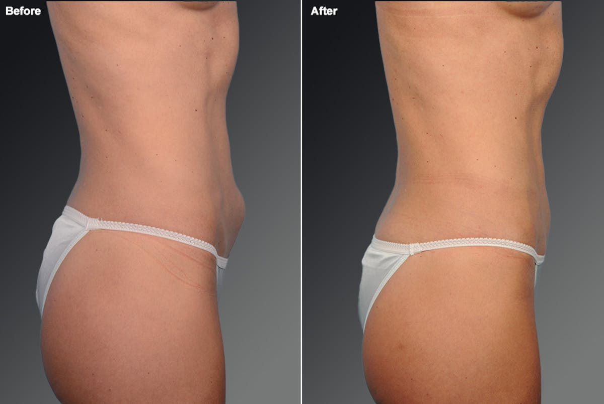 Tummy Tuck Before & After Gallery - Patient 105844369 - Image 1
