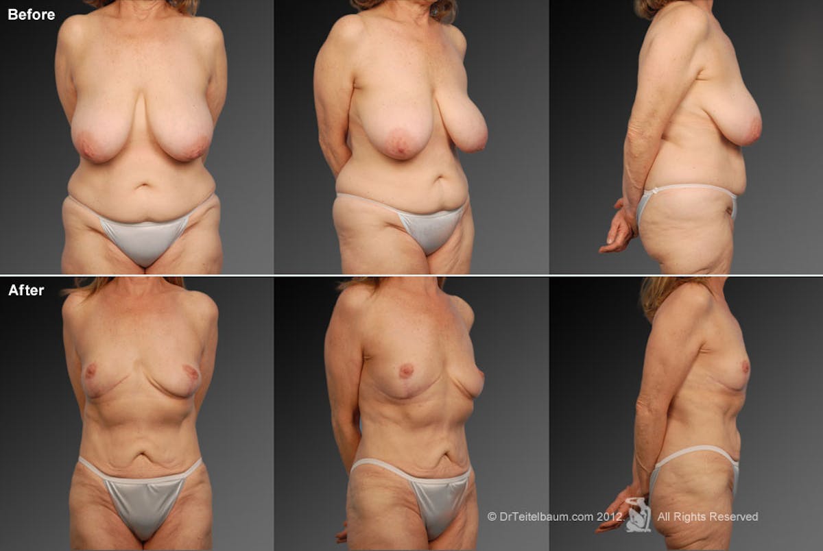 Tummy Tuck Before & After Gallery - Patient 106001945 - Image 1
