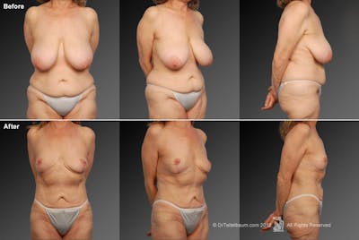 Tummy Tuck Before & After Gallery - Patient 106001945 - Image 1