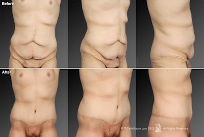 Tummy Tuck Before & After Gallery - Patient 106001946 - Image 1