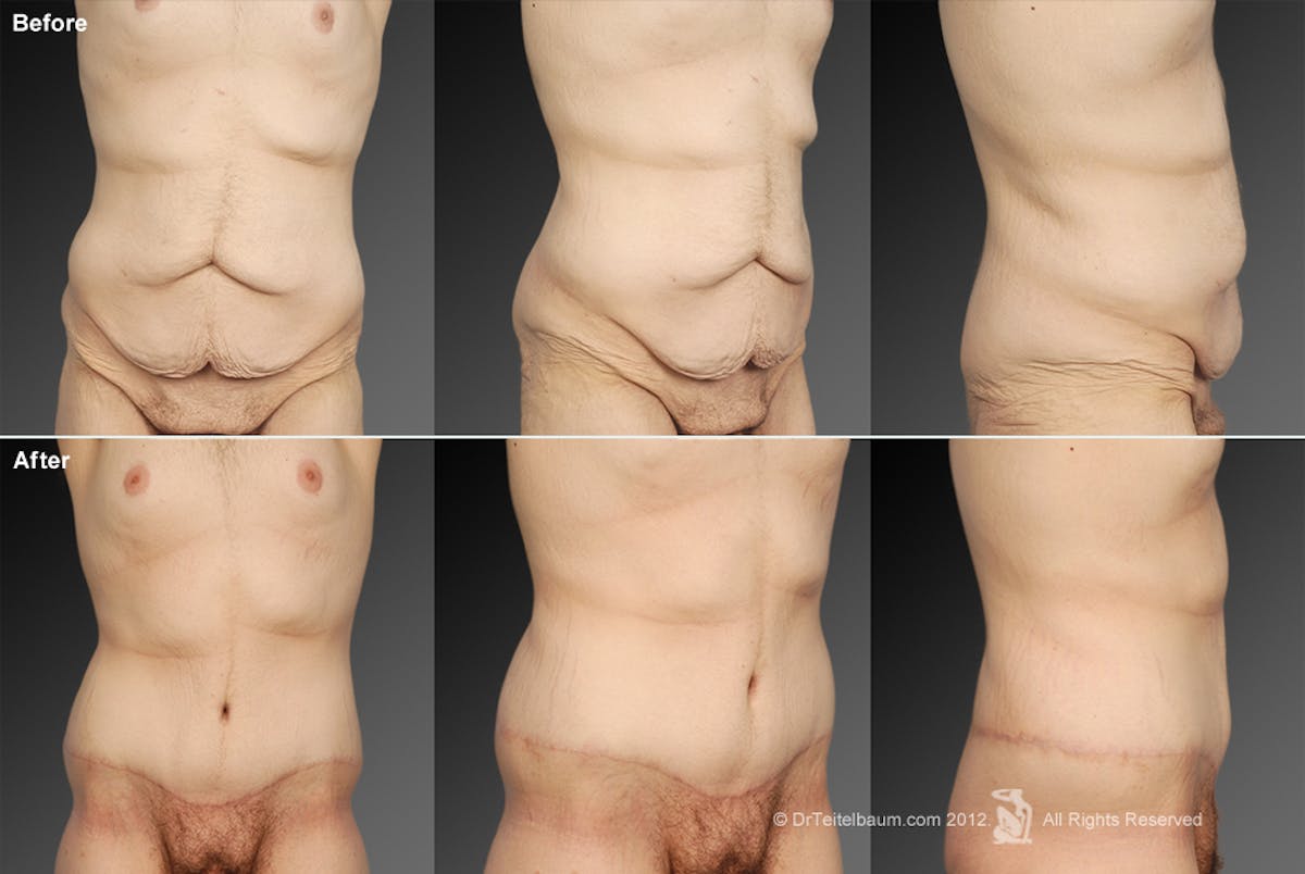 Tummy Tuck Before & After Gallery - Patient 106001946 - Image 1