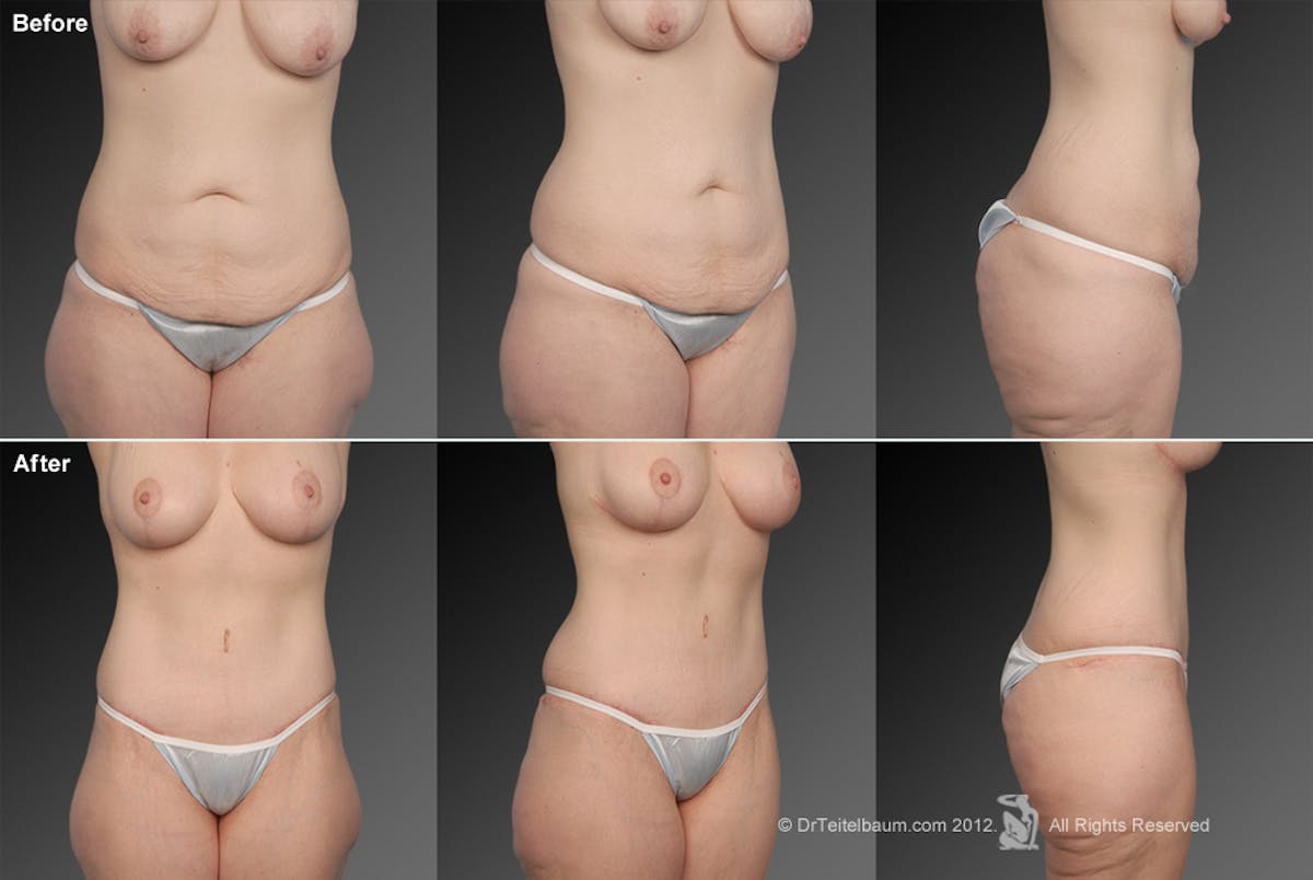 Tummy Tuck Before & After Gallery - Patient 106001947 - Image 1