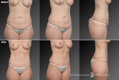 Tummy Tuck Before & After Gallery - Patient 106001947 - Image 1