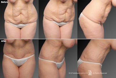 Tummy Tuck Before & After Gallery - Patient 106001950 - Image 1