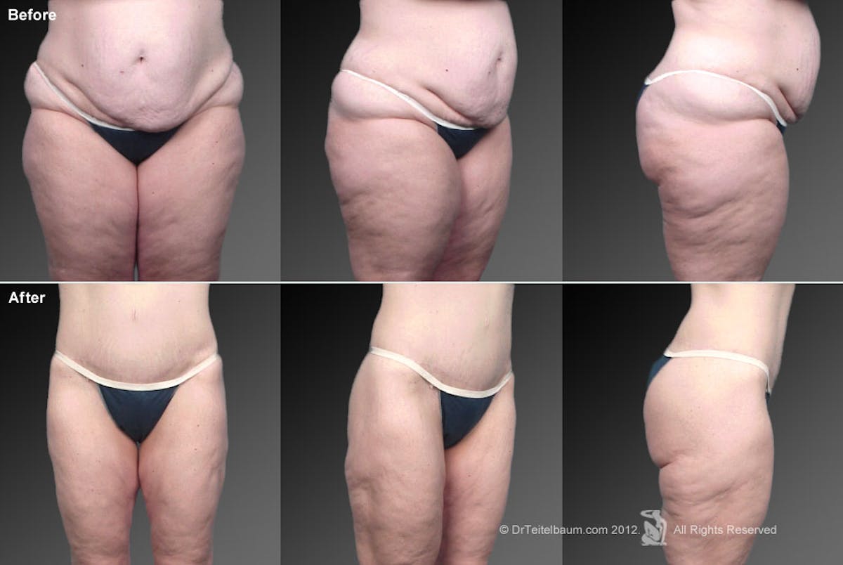 Tummy Tuck Before & After Gallery - Patient 106001951 - Image 1