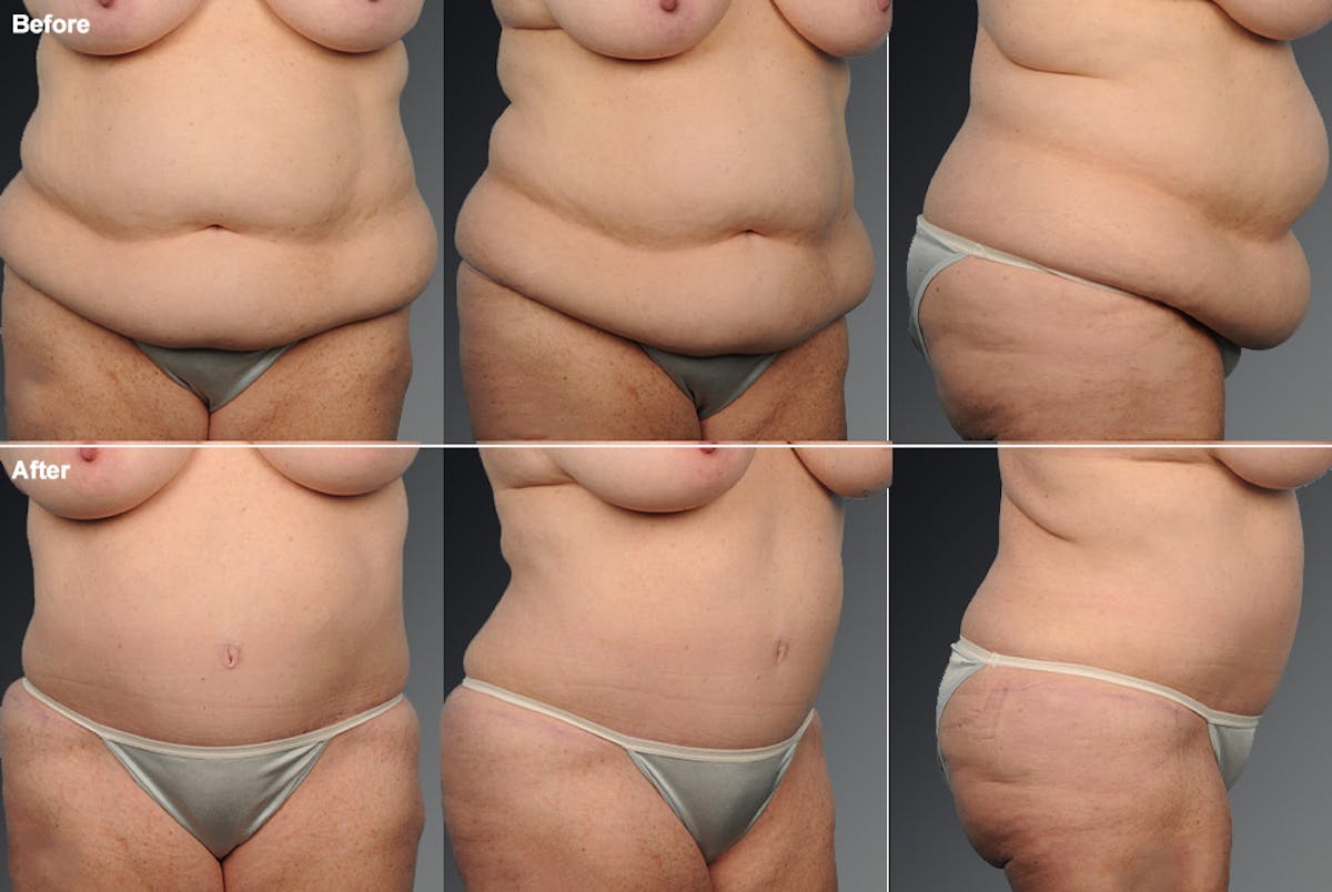 Tummy Tuck Before & After Gallery - Patient 106001953 - Image 1