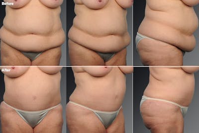 Tummy Tuck Before & After Gallery - Patient 106001953 - Image 1