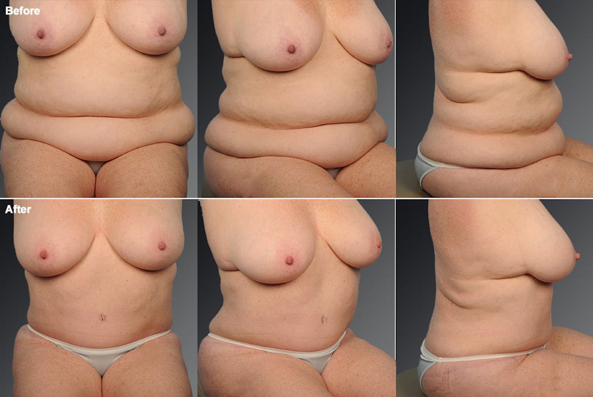 Tummy Tuck Before & After Gallery - Patient 106001954 - Image 1