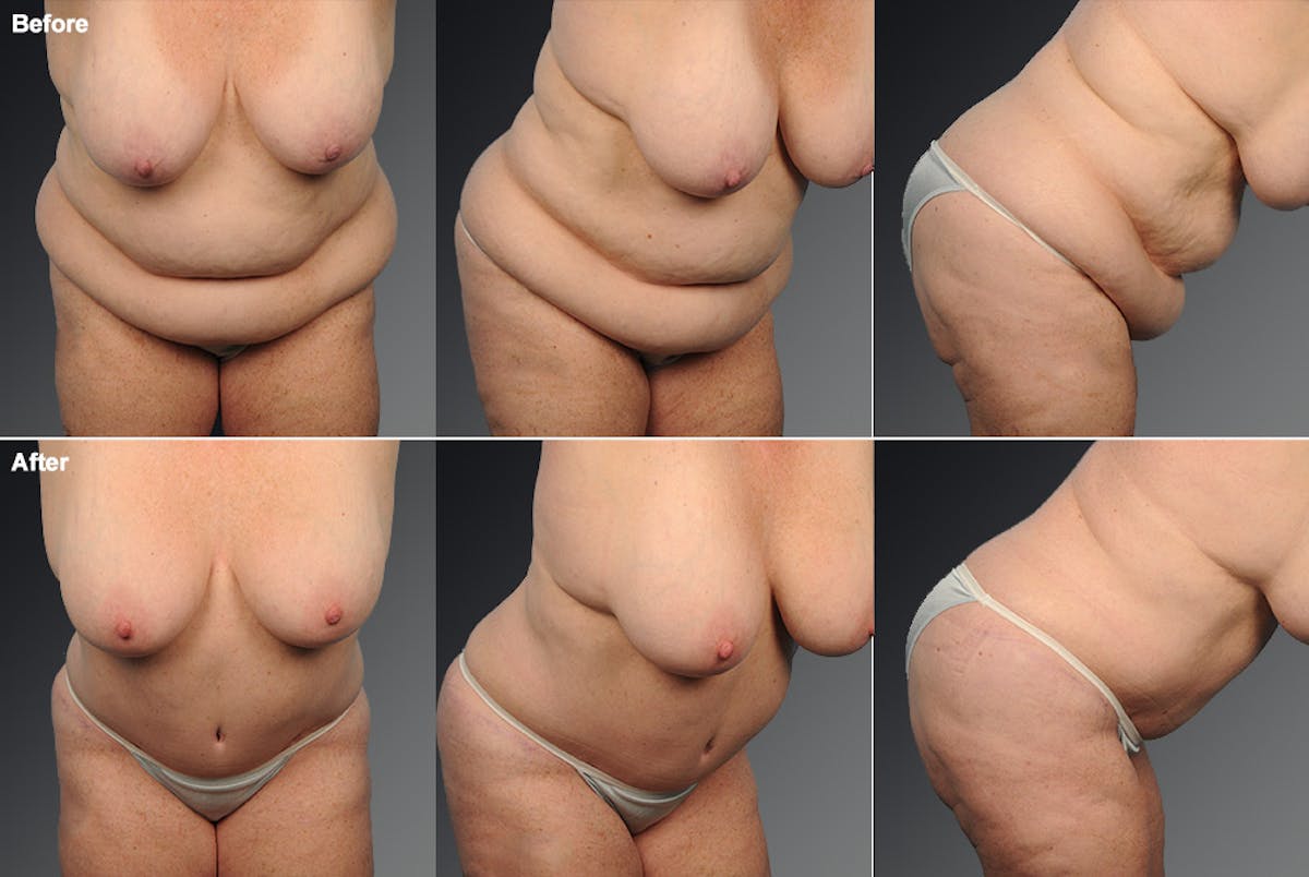 Tummy Tuck Before & After Gallery - Patient 106001955 - Image 1