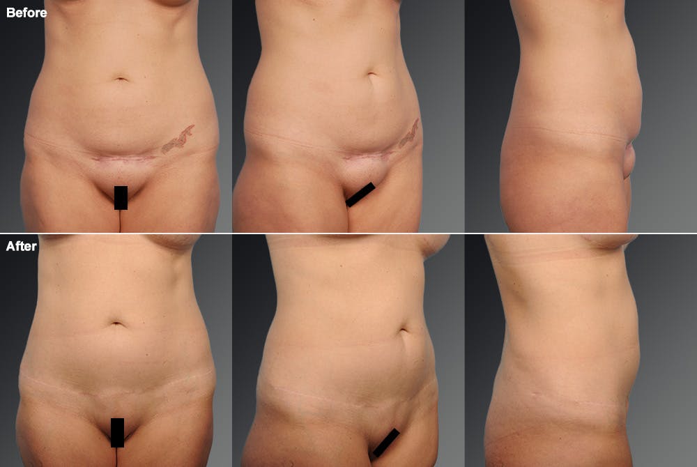 Tummy Tuck Before & After Gallery - Patient 106001956 - Image 1