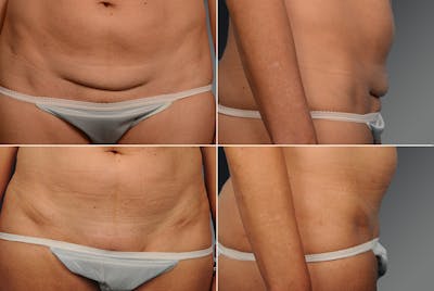 Tummy Tuck Before & After Gallery - Patient 106001957 - Image 1