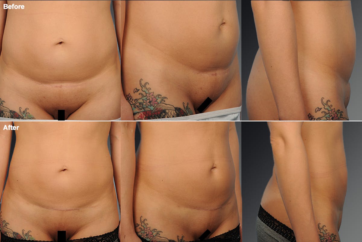Tummy Tuck Before & After Gallery - Patient 106001958 - Image 1