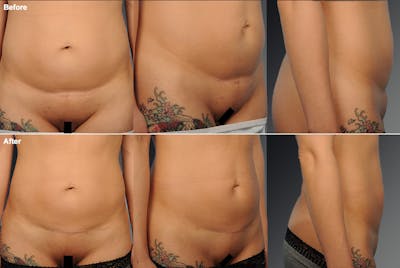 Tummy Tuck Before & After Gallery - Patient 106001958 - Image 1