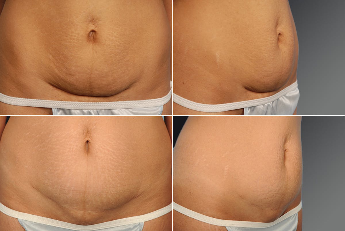 Tummy Tuck Before & After Gallery - Patient 106001959 - Image 1
