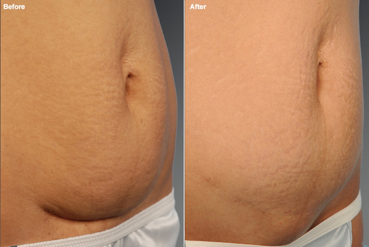 Tummy Tuck Before & After Gallery - Patient 106001960 - Image 1