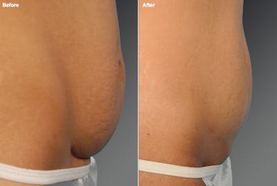 Tummy Tuck Before & After Gallery - Patient 106001961 - Image 1