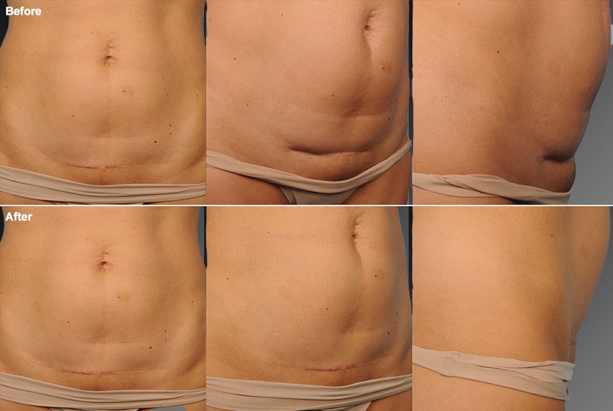 Tummy Tuck Before & After Gallery - Patient 106001962 - Image 1