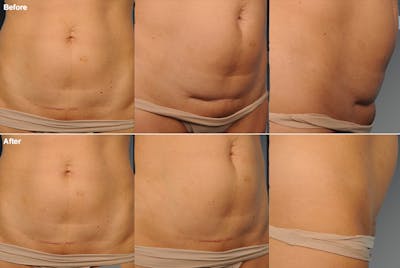 Tummy Tuck Before & After Gallery - Patient 106001962 - Image 1
