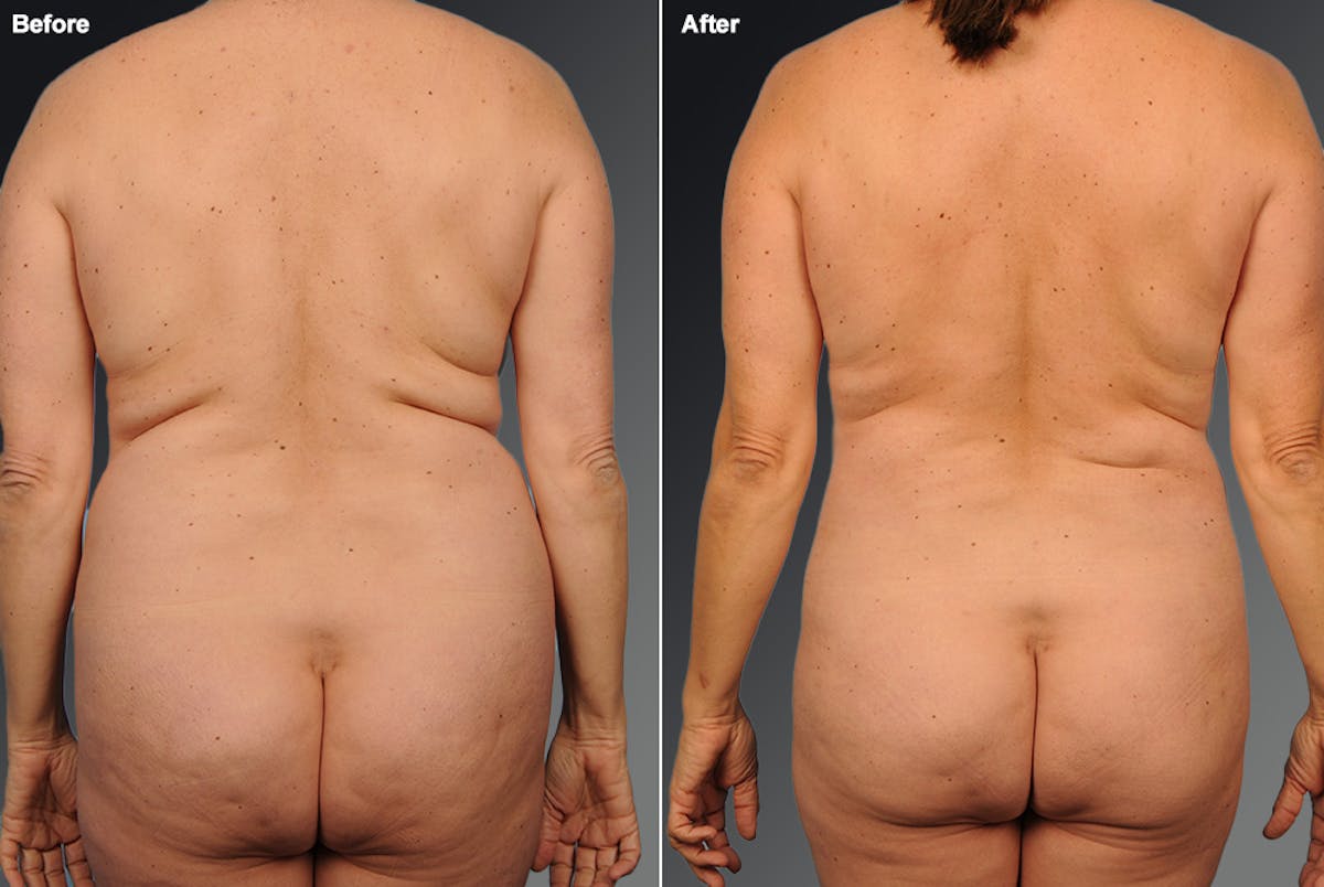 Liposuction Before & After Gallery - Patient 106009038 - Image 1