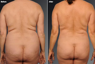 Liposuction Before & After Gallery - Patient 106009038 - Image 1