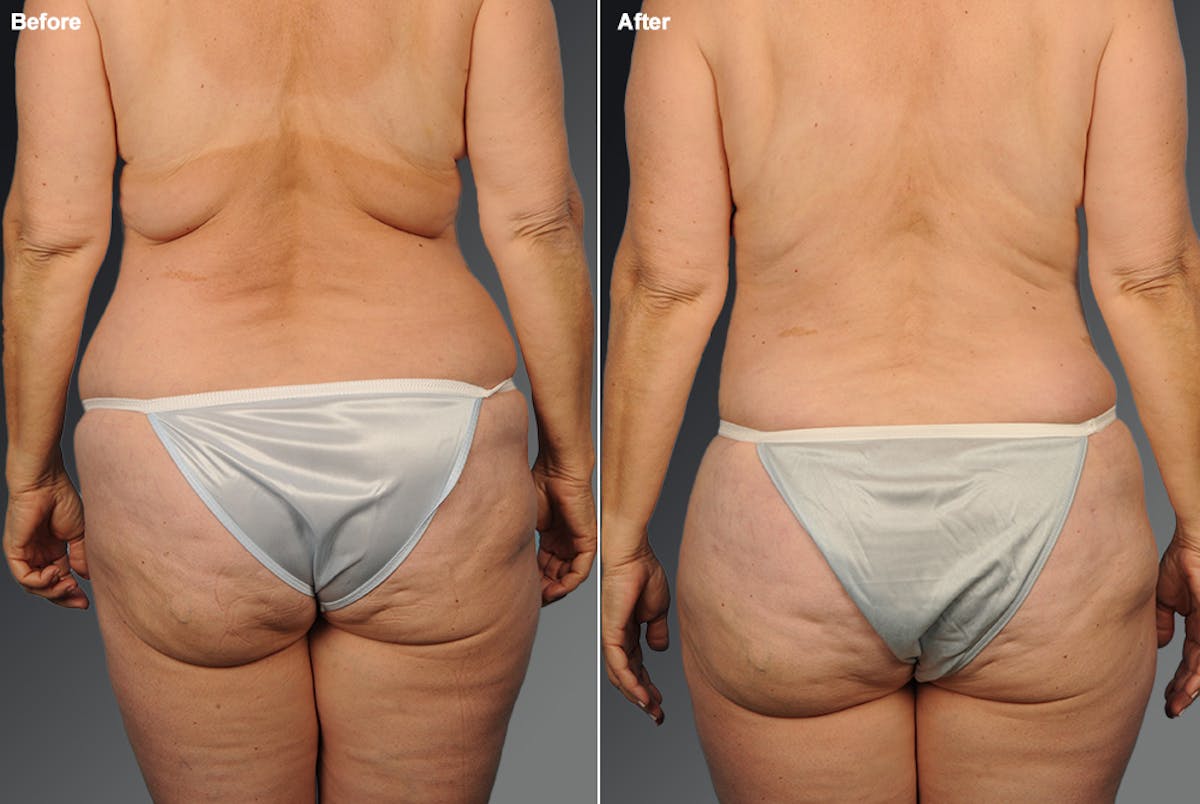 Liposuction Before & After Gallery - Patient 106009039 - Image 1