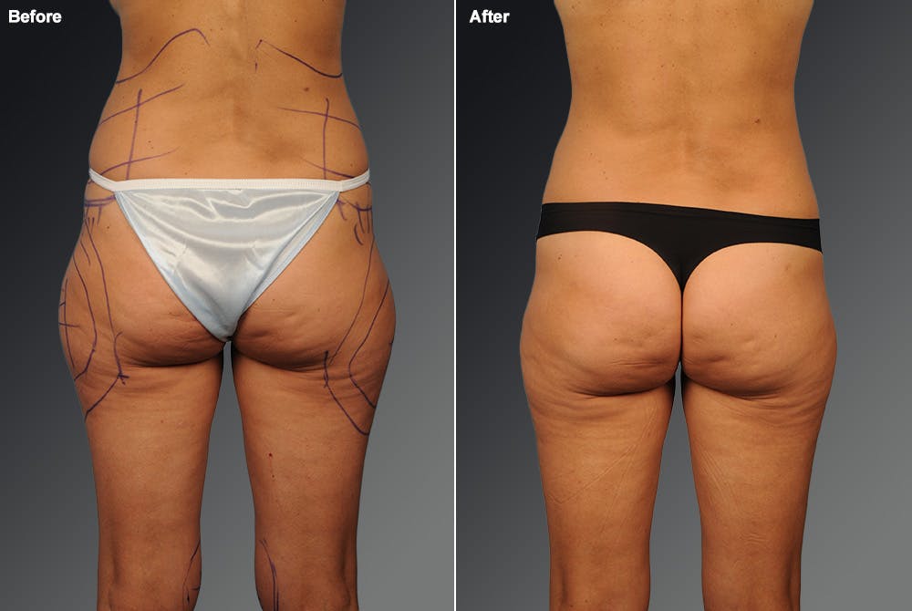 Liposuction Before & After Gallery - Patient 106009040 - Image 1