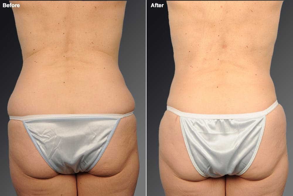 Liposuction Before & After Gallery - Patient 106009042 - Image 1