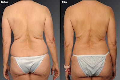 Liposuction Before & After Gallery - Patient 106009043 - Image 1
