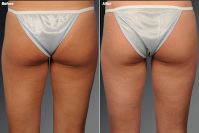 Liposuction Before & After Gallery - Patient 106009044 - Image 1