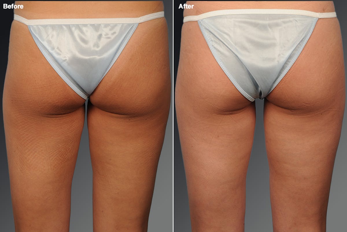 Liposuction Before & After Gallery - Patient 106009044 - Image 1