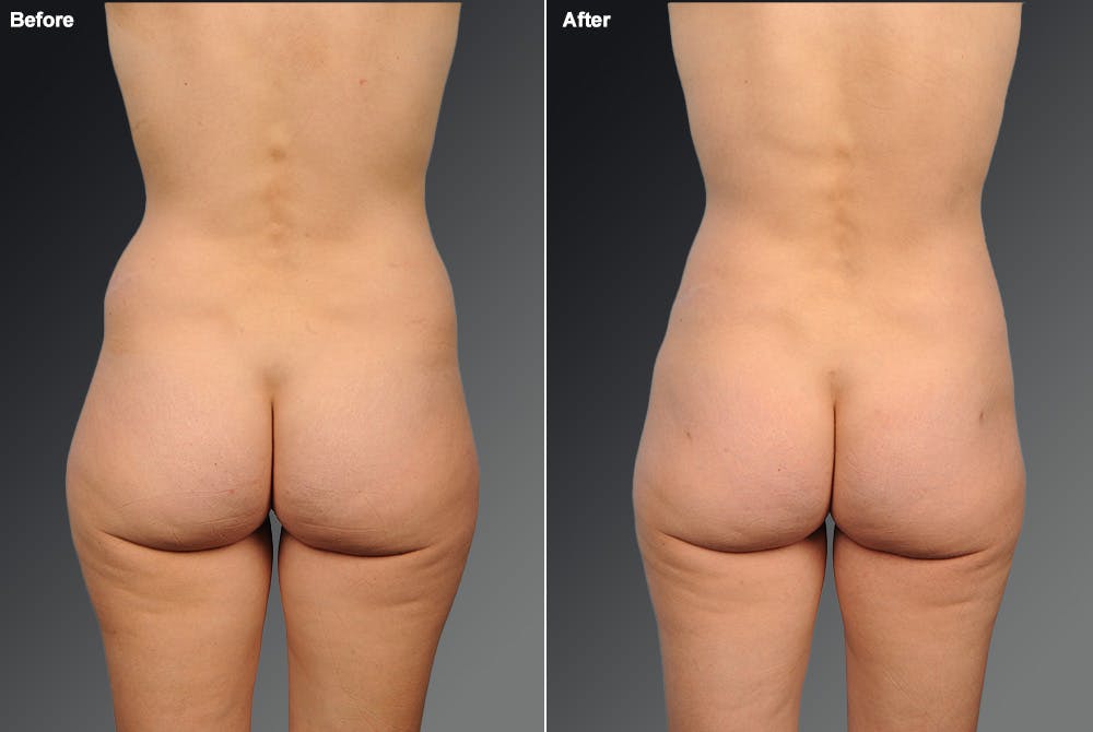 Liposuction Before & After Gallery - Patient 106009045 - Image 1