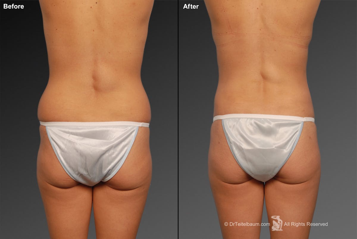 Liposuction Before & After Gallery - Patient 106009046 - Image 1