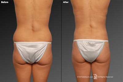 Liposuction Before & After Gallery - Patient 106009046 - Image 1