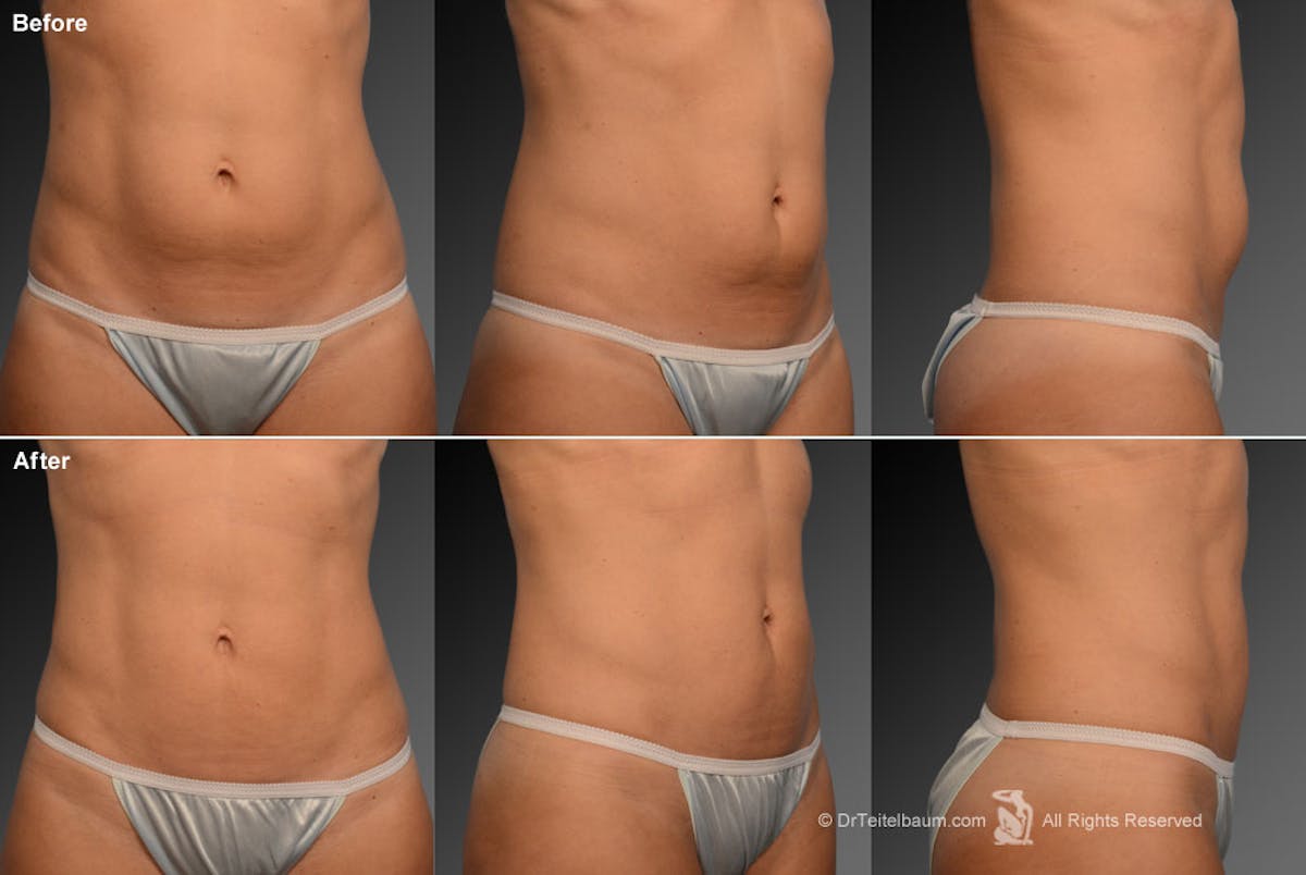 Liposuction Before & After Gallery - Patient 106009047 - Image 1