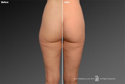 Liposuction Before & After Gallery - Patient 106009048 - Image 1