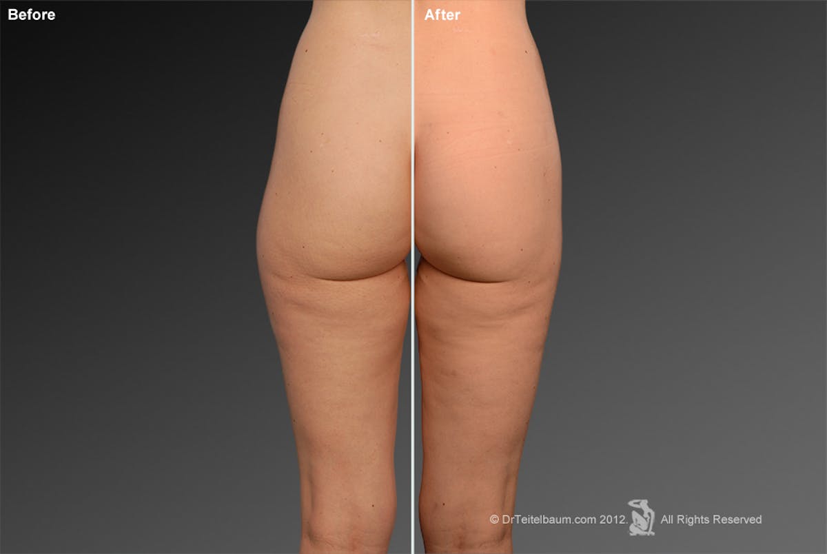 Liposuction Before & After Gallery - Patient 106009048 - Image 1
