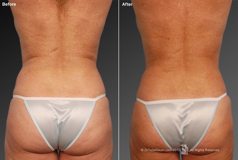 Liposuction Before & After Gallery - Patient 106009049 - Image 1