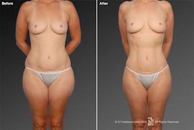 Liposuction Before & After Gallery - Patient 106009050 - Image 1