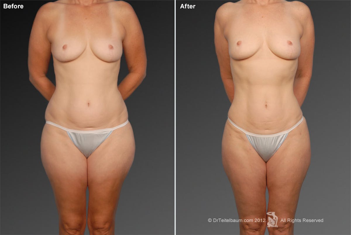 Liposuction Before & After Gallery - Patient 106009050 - Image 1
