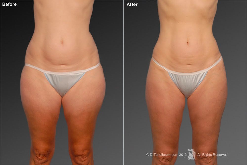 Liposuction Before & After Gallery - Patient 106009051 - Image 1
