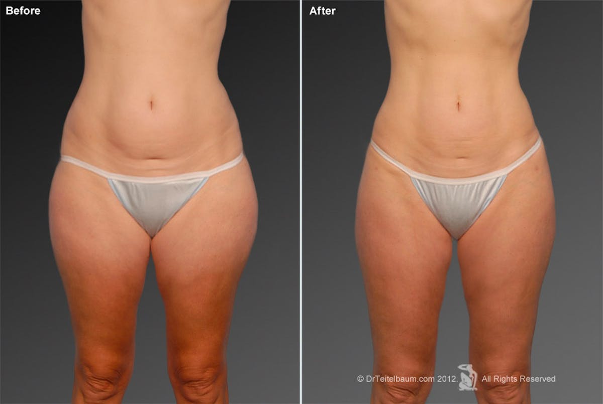 Liposuction Before & After Gallery - Patient 106009051 - Image 1