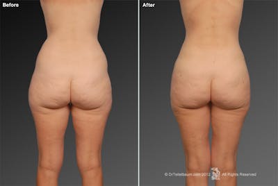 Liposuction Before & After Gallery - Patient 106009052 - Image 1