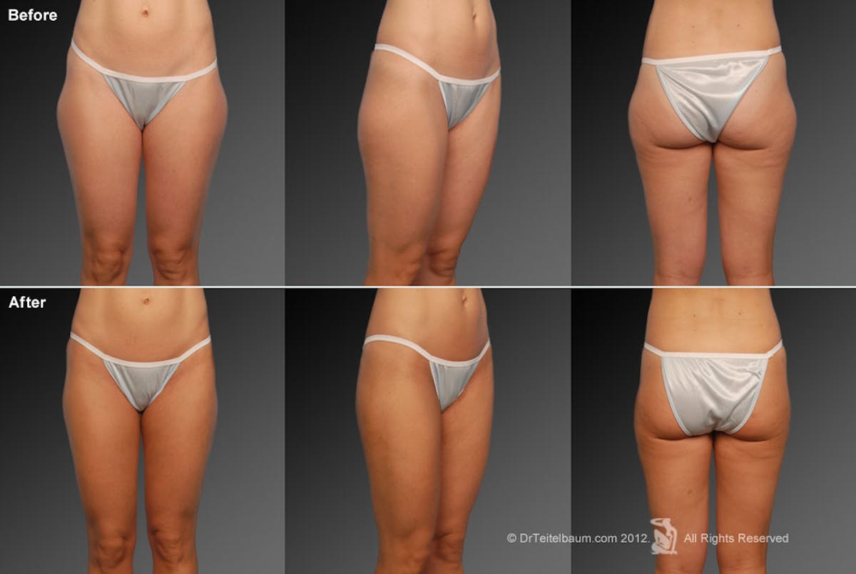 Liposuction Before & After Gallery - Patient 106009053 - Image 1