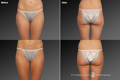 Liposuction Before & After Gallery - Patient 106009054 - Image 1
