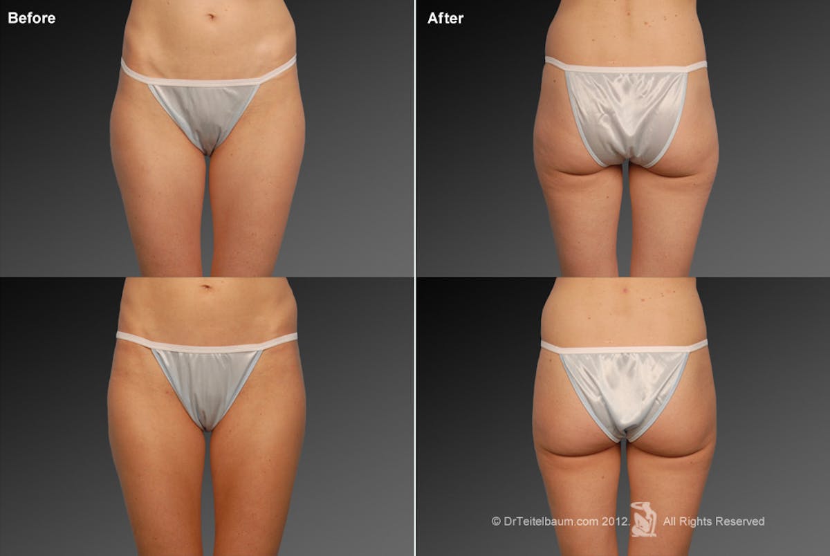 Liposuction Before & After Gallery - Patient 106009054 - Image 1
