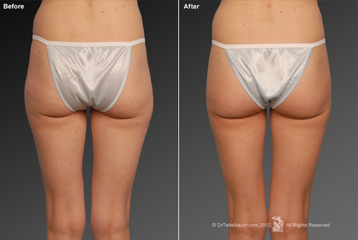 Liposuction Before & After Gallery - Patient 106009055 - Image 1