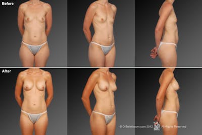 Liposuction Before & After Gallery - Patient 106009056 - Image 1