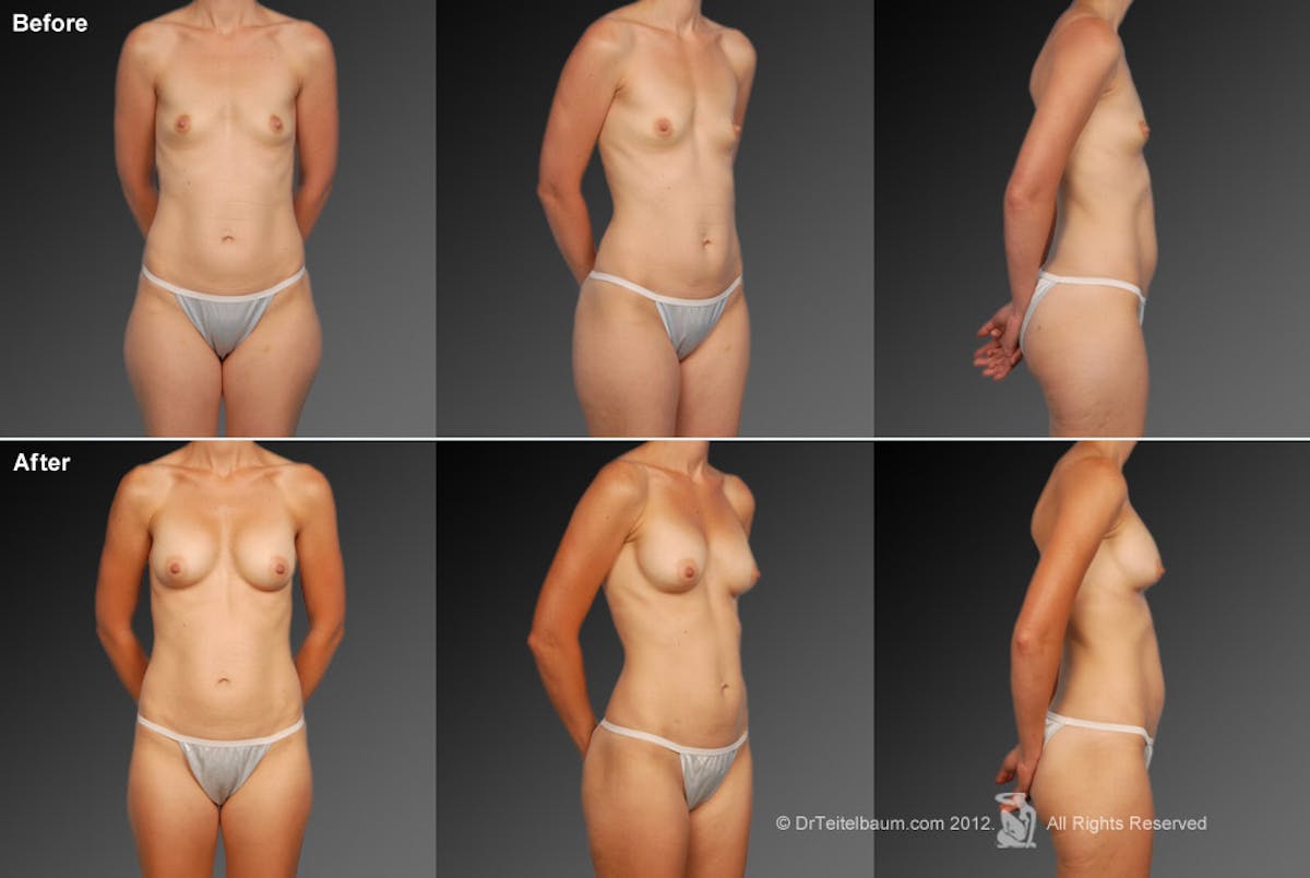 Liposuction Before & After Gallery - Patient 106009056 - Image 1
