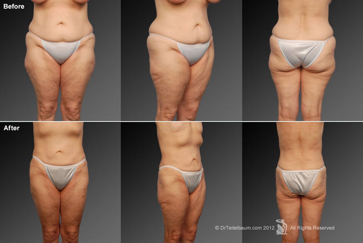 Liposuction Before & After Gallery - Patient 106009057 - Image 1