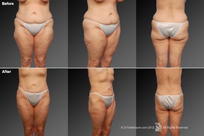 Liposuction Before & After Gallery - Patient 106009057 - Image 1